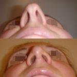 całkowita zmiana kształtu nosa