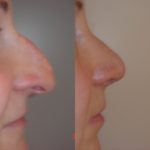 zmiana kształtu nosa