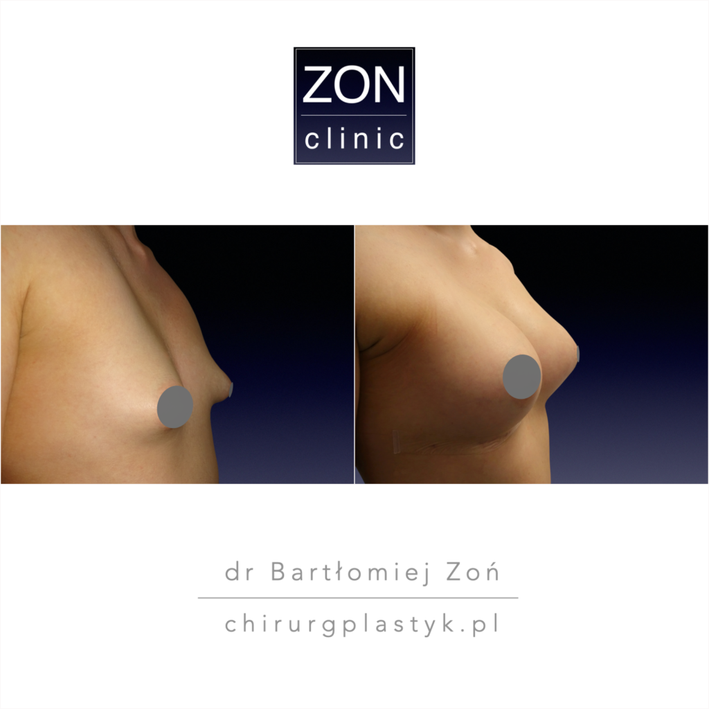 implanty piersi  dr Bartłomiej Zoń ZON CLINIC