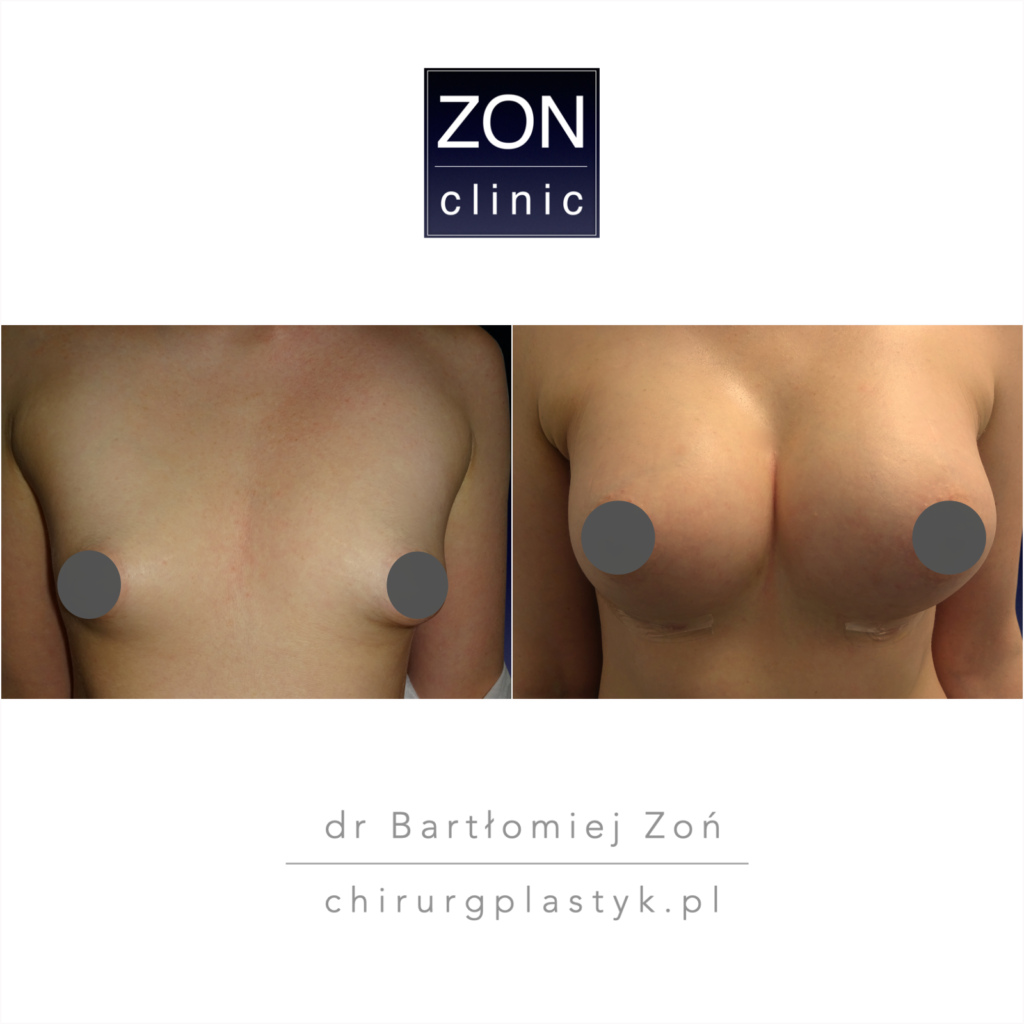 implanty piersi  dr Bartłomiej Zoń ZON CLINIC